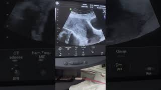 Two different cases of Endometrial Hyperplasia diagnostic ultrasound cases [upl. by Claudetta687]