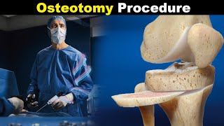 How Osteotomy Procedure Is Performed  Osteotomy Types UrduHindi [upl. by Yssej220]