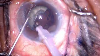 Phacoemulsification of brown cataract follow the basics [upl. by Nali]