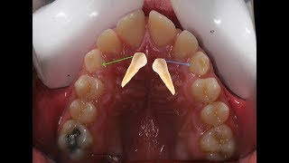 Orthodontic treatment of bilateral palataly deep impacted canines Yazan 14 yrs [upl. by Hibbert918]