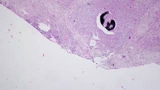 Actinomycosis in Liver with GMSHaematoxylin and Eosin Staining [upl. by Trici864]