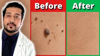 How to Rid Skin Tags FASTER  3 Easy Skin Tag Removal Steps [upl. by Ahsien]