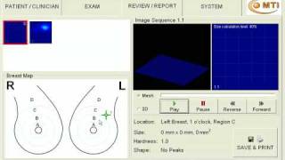 Dense Fibroglandular Tissue [upl. by Litta]