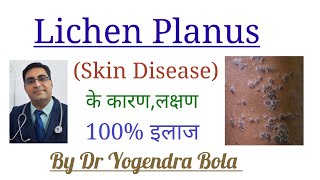 Lichen Planus  Skin Disease  के कारण लक्षण और 100 इलाज  By Dr Yogendra Bola [upl. by Fagen]