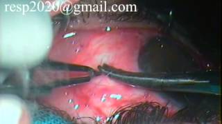 Conjunctival Graft Suturing For Pterygium Excision With Autograft By Dr Sudhir Singh 33 [upl. by Cyna]