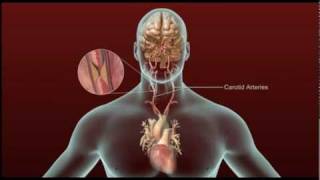 Stroke  Carotid Artery Disease and TIA [upl. by Luthanen]