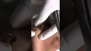 Warts Removal Treatment  Safe and Effective Wart Removal Treatment  Skinaa Clinic viral ytshorts [upl. by Sapienza]