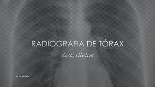 Radiografia de Tórax Casos Clínicos [upl. by Faustine]