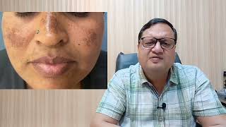 Pigmentation Treatment Price  Laser Pigmentation Treatment  Causes  Kayakalp Laser Clinic [upl. by Hirsch]