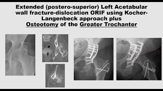 Tension band and cerclage wiring techniques for fracture fixation [upl. by Scevour345]