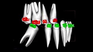 Uprighting molars with the Straight wire system part 1 [upl. by Anasiul]