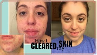 HOW I CLEARED MY SKIN  My Journey with Curology [upl. by Sielen]