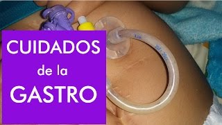 Gastrostomía  Lavado de sonda y como evitar taponamientos [upl. by Kama]