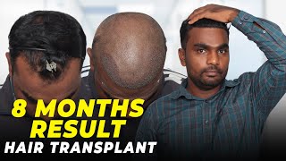 Hair Transplant in Bhopal  Best Results amp Cost of Hair Transplant in Bhopal [upl. by Gerdi]