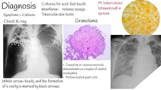 Tuberculosis  Symptoms causes and treatment [upl. by Sherj]