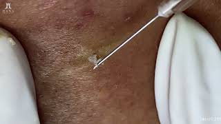 Big Cystic Acne Blackheads Extraction Blackheads amp Milia Whiteheads Removal Pimple Popping [upl. by Uyekawa]