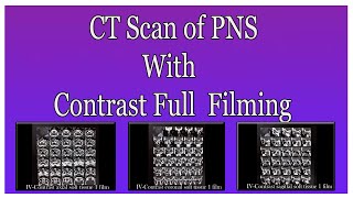 CT scan of PNS with contrast filming [upl. by Niela827]