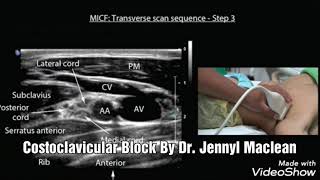 Costoclavicular Block [upl. by Carlene]