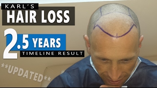 FUE Hair Transplant – Karl’s 25 Years Timeline Result  Hair loss treatment  baldness for Men 2016 [upl. by Koziarz]