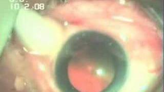 Intravitreal Injection Avastin In WET AMD Dr Sudhalkar [upl. by Dulcia]