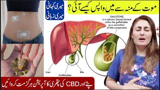 How To Remove Gallbladder Stone Without Surgery Gallbladder Stones Treatment Without Operation [upl. by Eydnarb]