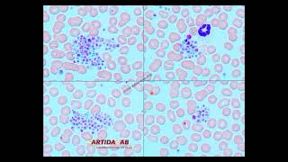 Agregación plaquetaria in vitro [upl. by Mccord]