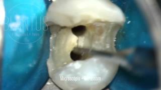 Microsonic in Endodontics [upl. by Egarton]