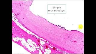 Simple mucinous cyst Pancreas [upl. by Lilaj]