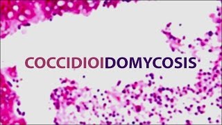 Coccidioidomycosis Valley Fever  Pediatric Grand Grounds  Mattel Childrens Hospital UCLA [upl. by Tireb]