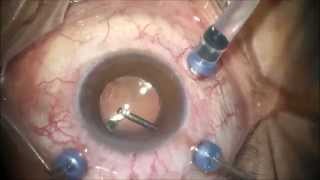 vitrectomy  uveitis [upl. by Cassiani]