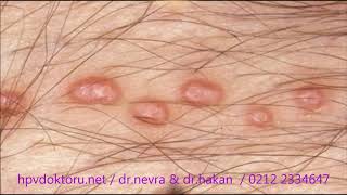 molluskum kontagiozum moloskum tedavisi resimleri görüntüleri video Molluscum contagiosum HPV [upl. by Eleirbag984]