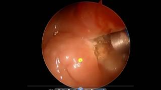 Adenoid removal [upl. by Worrad]