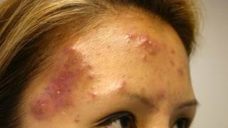 The Acne Practice severe case 5 [upl. by Khorma612]