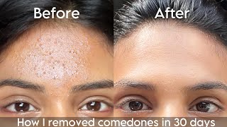 How I removed tiny white bumps from my forehead in 30 days  How to get rid of closed comedones [upl. by Yvonne]