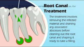 D31 Root Canal [upl. by Lim]