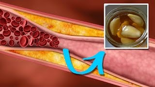 How to Lower Triglycerides Quickly and Naturally [upl. by Nea952]