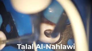 Fiber post removal A to Z in root canal retreatment by TALAL ALNAHLAWI د طلال النحلاوي [upl. by Rosati]