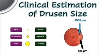 Clinical Estimation of Drusen Size [upl. by Binnings868]