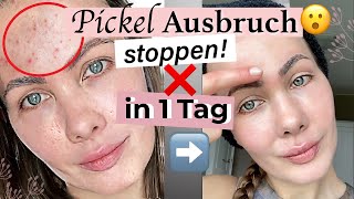 Meine 🆘Methode Pickel in 1 Tag loswerden [upl. by Ardnaid438]