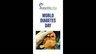 World Diabetes Day [upl. by Ahsienak]