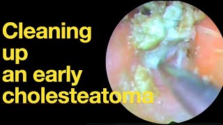 Cleaning up an early cholesteatomaear wax removal  ear cleaning  ASMR  relaxation  relax [upl. by Aldredge662]