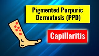 Pigmented purpuric dermatosis Capillaritis overview clinical features histology and management [upl. by Manchester536]