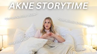 AKNE STORYTIME  Pille absetzen Isotretinoin Erfahrungen amp VorherNachher Bilder ✨ [upl. by Hendon]