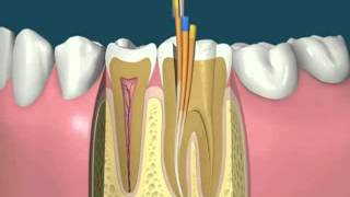 RCT Obturation [upl. by Dedra]
