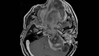 Skull Base Myxoid Sarcoma [upl. by Nnaik41]