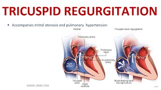 TRICUSPID REGURGITATION [upl. by Alleunamme]