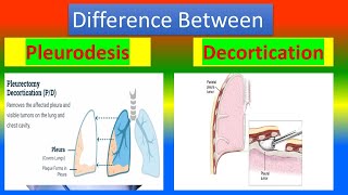 Difference between Pleurodesis and Decortication [upl. by Roger110]