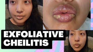 Exfoliative Cheilitis  Ointments amp Creams  Short Chitchat [upl. by Asilet]