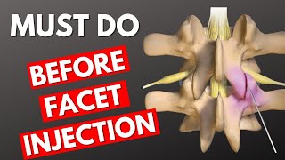 Before Facet Injection Do This  Lumbar Facet Injection [upl. by Engen]