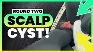 SCALP CYST ROUND TWO [upl. by Hersh]